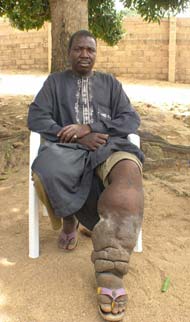 Sitting on a white plastic chair, Hamisu Isa, 35, listens to members of his lymphatic filariasis support group describe their symptoms, challenges, successes, and hopes.